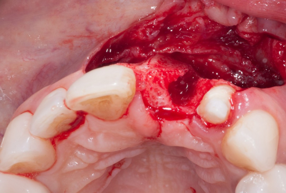 Augmentation with maxgraft® cortico - Dr. K. Chmielewski