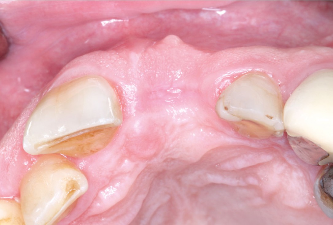 GBR using layering technique in aesthetic zone with maxgraft® and cerabone® -Dr. H. Maghaireh and Dr. V. Ivancheva
