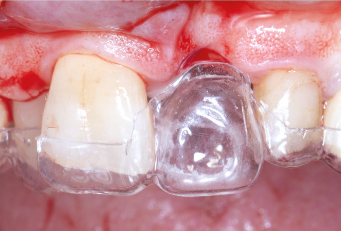 GBR using layering technique in aesthetic zone with maxgraft® and cerabone® -Dr. H. Maghaireh and V. Ivancheva