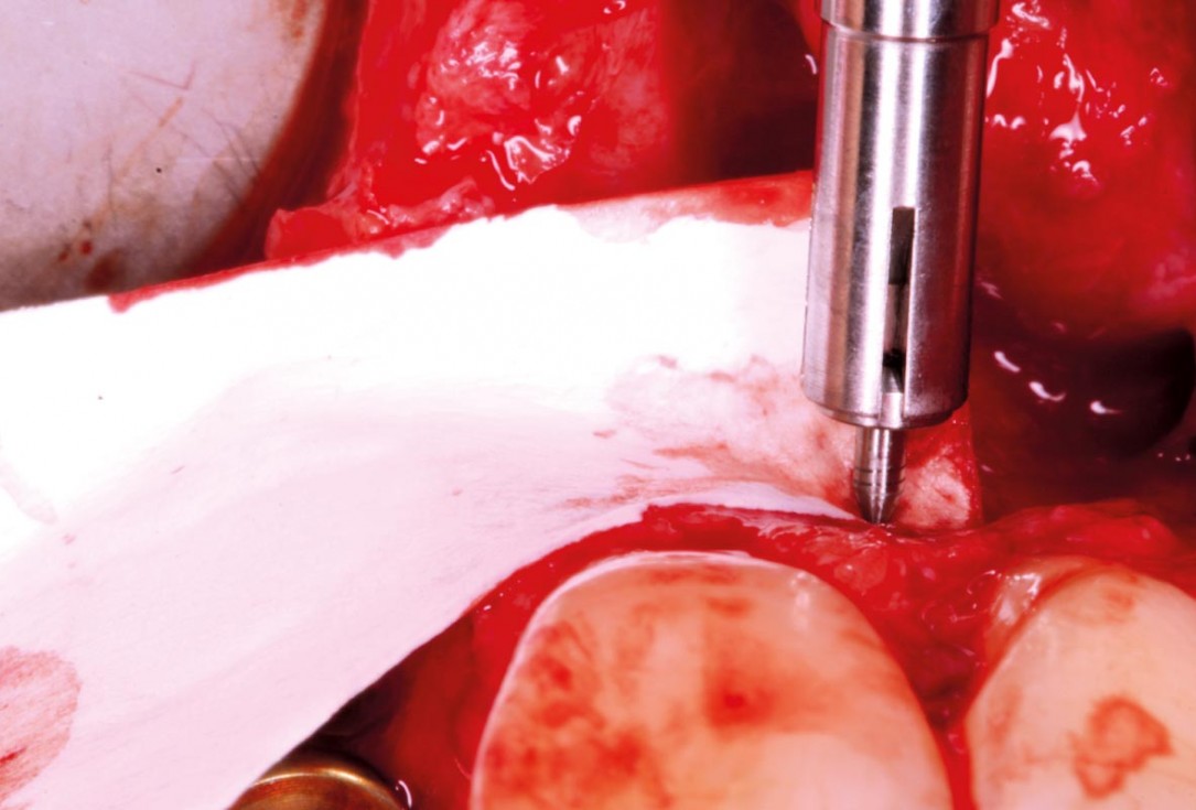 Delayed implant placement with GBR and soft tissue augmentation at the aesthetic area  -  2 years follow up – Dr. H. Maghaireh & Dr. V. Ivancheva