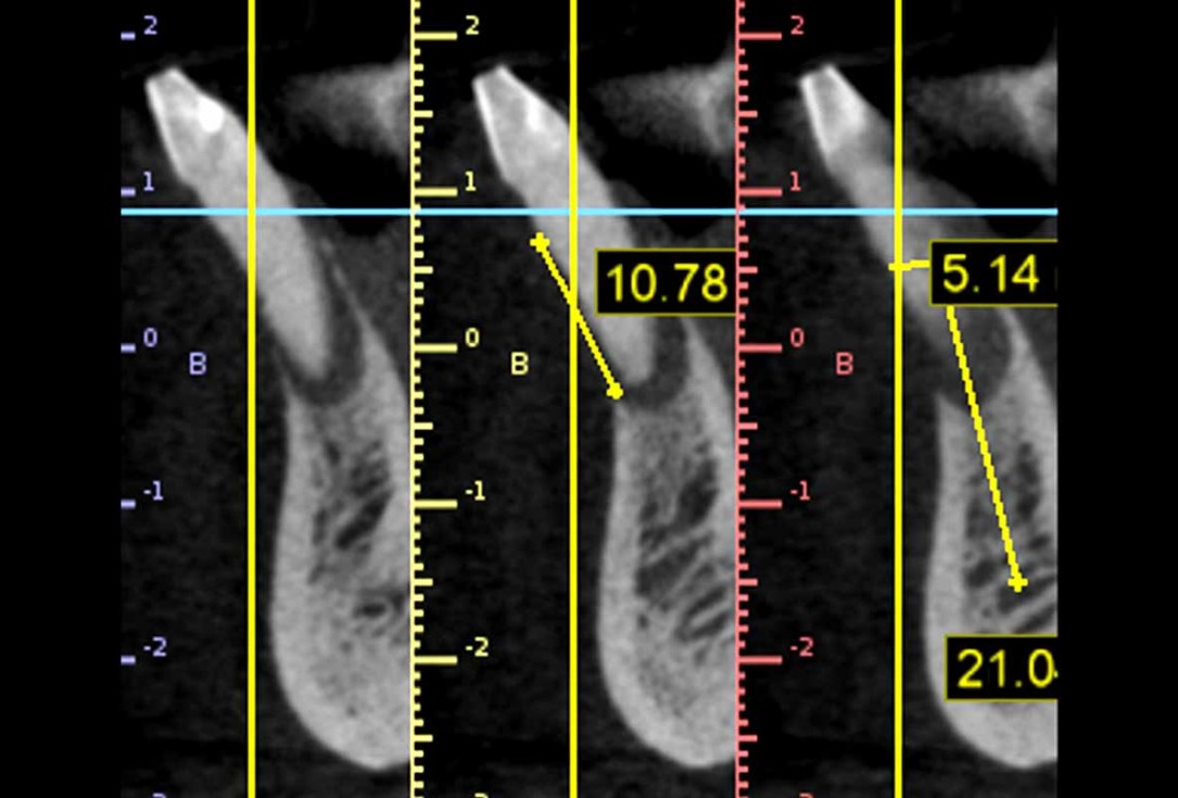 botiss cerabone and mucoderm for bone regeneration and implant supported rehabilitation of a periodontally involved incisor - clinical case