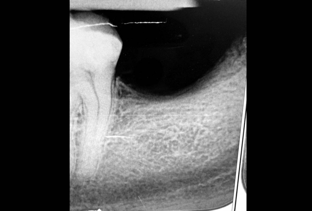 Vertical bone augmentation and broadening of attached gingiva using cerabone, permamem and mucoderm  -  Dr. R. Naimoli