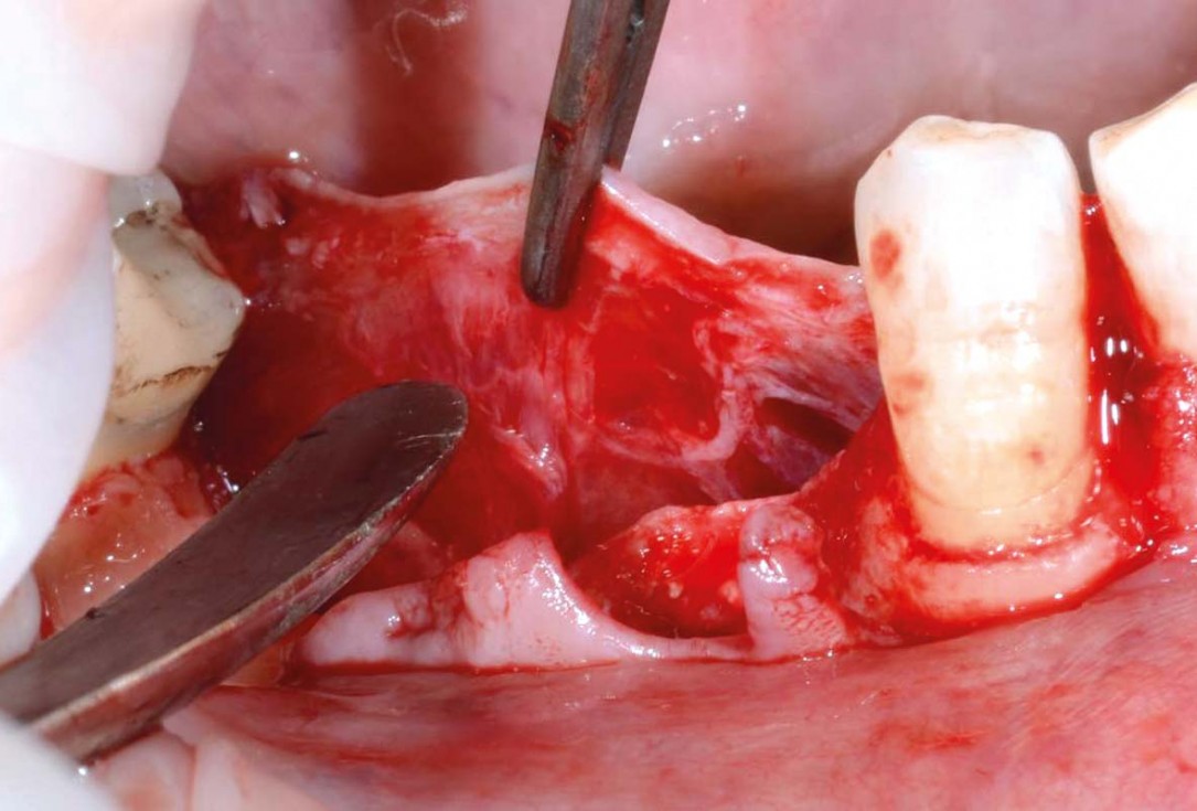 Vertical bone augmentation and broadening of attached gingiva using cerabone, permamem and mucoderm  -  Dr. R. NaimoliVertical bone augmentation and broadening of attached gingiva using cerabone, permamem and mucoderm  -  Dr. R. Naimoli