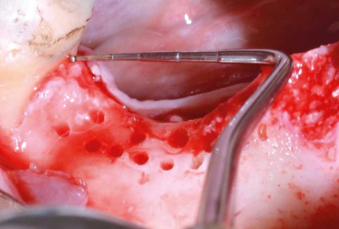 Vertical bone augmentation and broadening of attached gingiva using cerabone, permamem and mucoderm  -  Dr. R. Naimoli