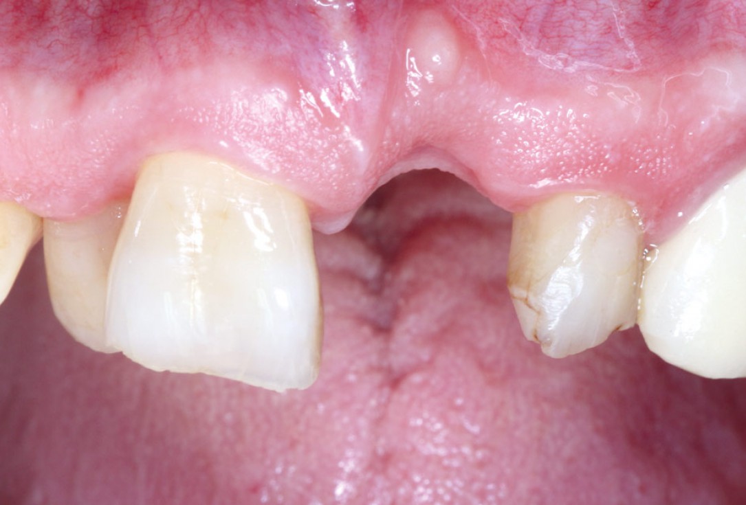 GBR using layering technique in aesthetic zone with maxgraft® and cerabone® -Dr. H. Maghaireh and Dr. V. Ivancheva