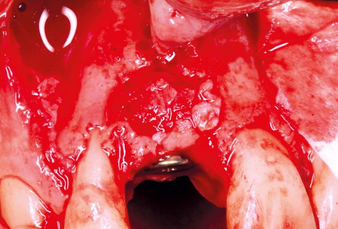 Delayed implant placement with GBR and soft tissue augmentation at the aesthetic area  -  2 years follow up – Dr. H. Maghaireh & Dr. V. Ivancheva