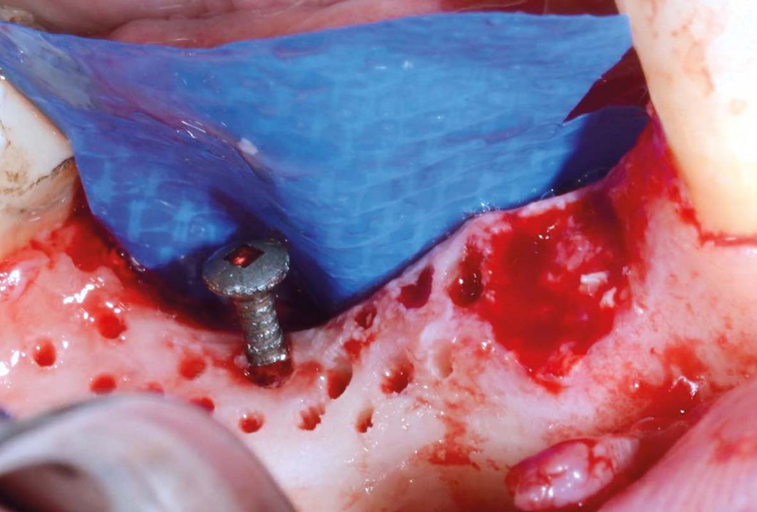 Vertical bone augmentation and broadening of attached gingiva using cerabone, permamem and mucoderm  -  Dr. R. Naimoli