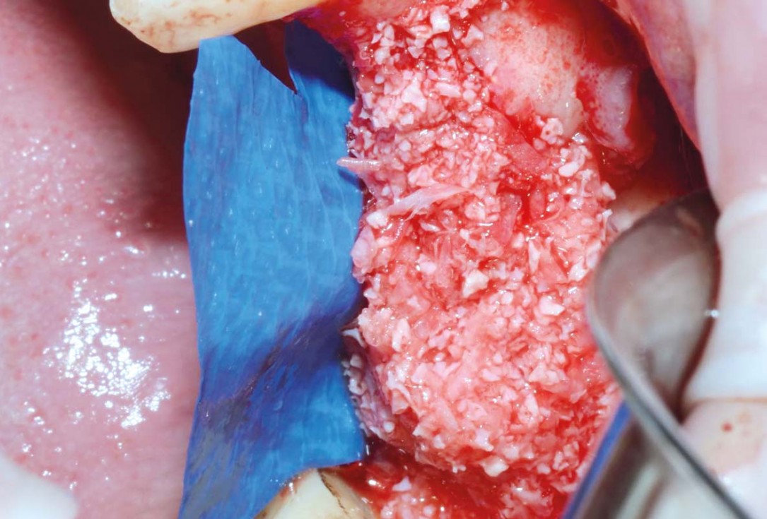 Vertical bone augmentation and broadening of attached gingiva using cerabone, permamem and mucoderm  -  Dr. R. Naimoli