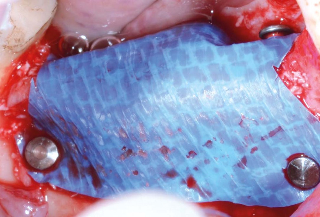 Vertical bone augmentation and broadening of attached gingiva using cerabone, permamem and mucoderm  -  Dr. R. Naimoli