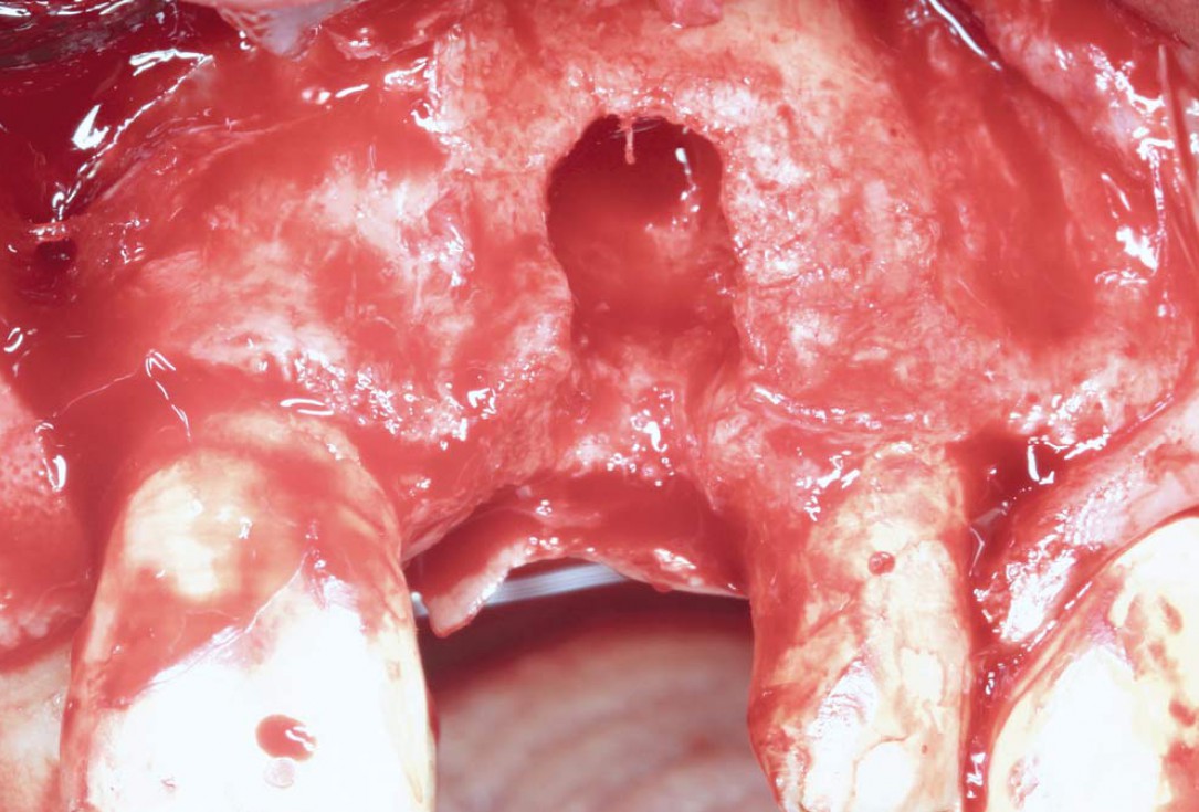 GBR using layering technique in aesthetic zone with maxgraft® and cerabone® -Dr. H. Maghaireh and Dr. V. Ivancheva