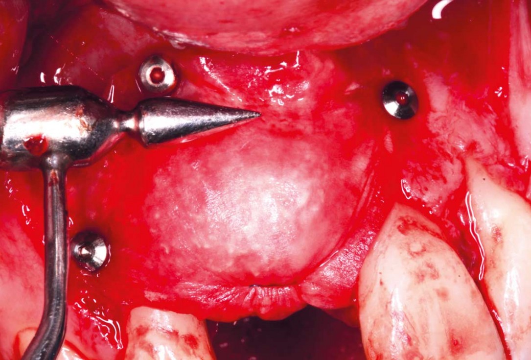 Delayed implant placement with GBR and soft tissue augmentation at the aesthetic area  -  2 years follow up – Dr. H. Maghaireh & Dr. V. Ivancheva