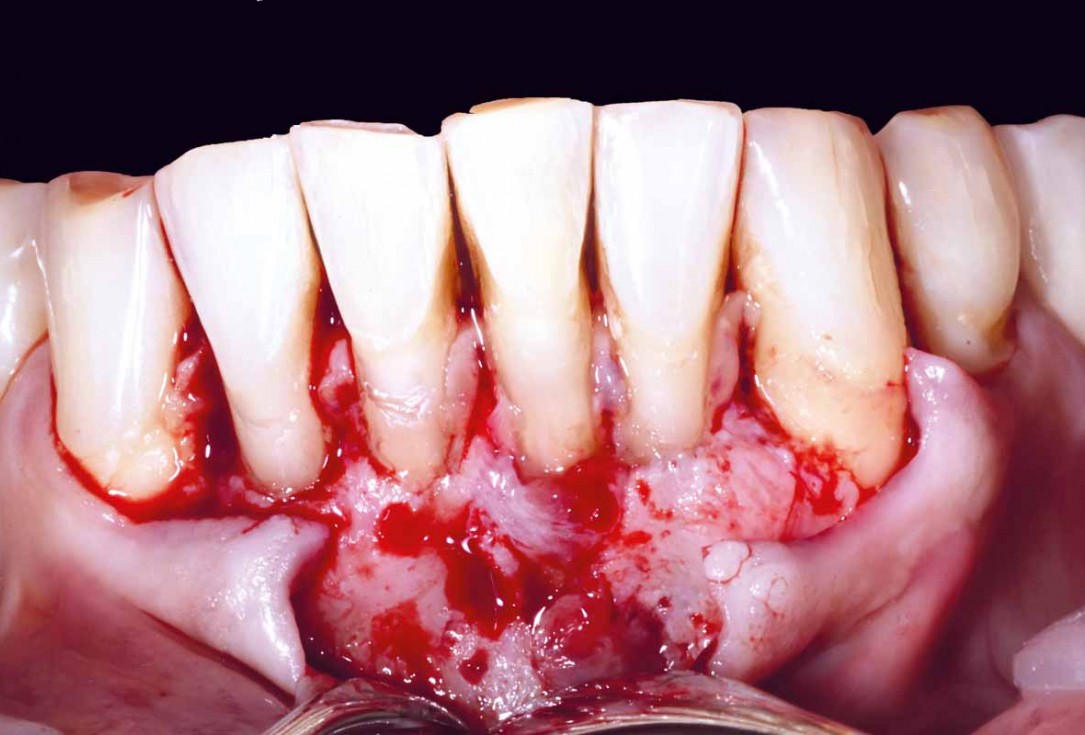 botiss cerabone and mucoderm for bone regeneration and implant supported rehabilitation of a periodontally involved incisor - clinical case