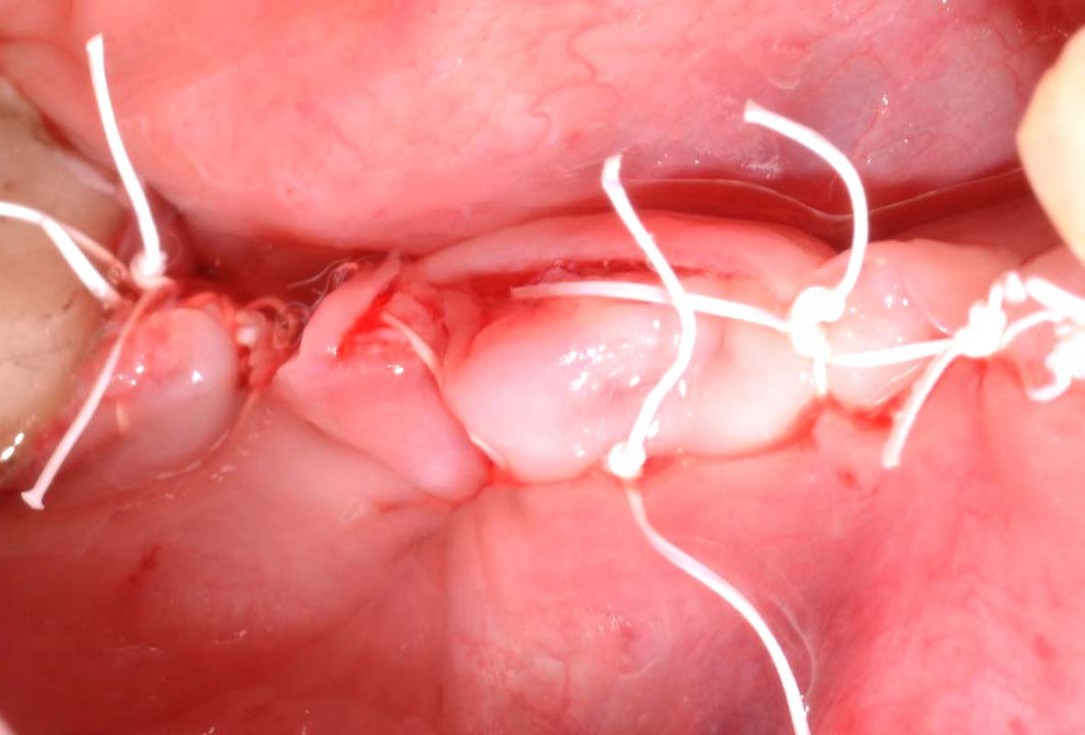 Vertical bone augmentation and broadening of attached gingiva using cerabone, permamem and mucoderm  -  Dr. R. Naimoli