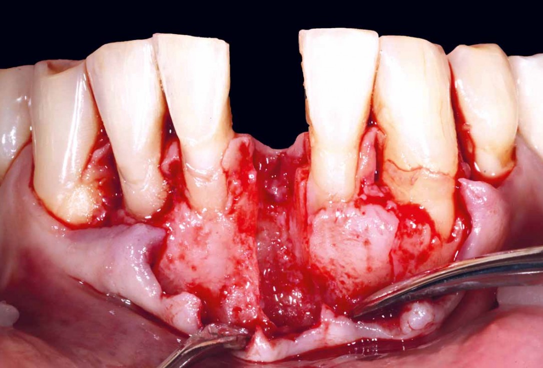 botiss cerabone and mucoderm for bone regeneration and implant supported rehabilitation of a periodontally involved incisor - clinical case