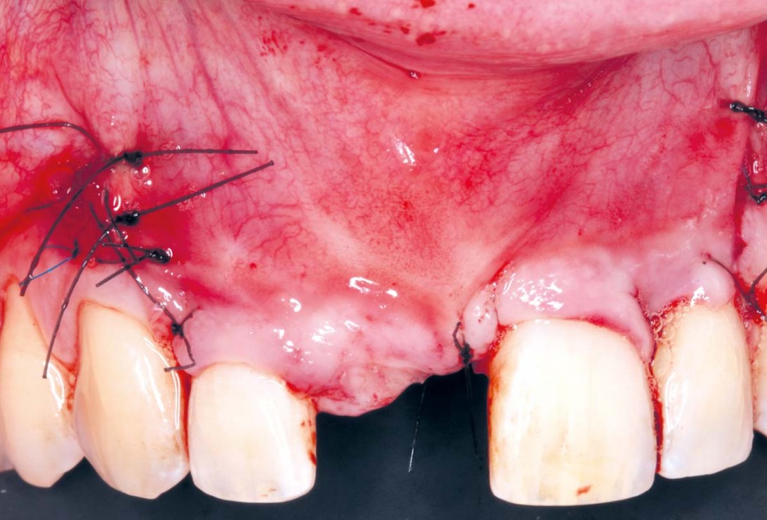 Delayed implant placement with GBR and soft tissue augmentation at the aesthetic area  -  2 years follow up – Dr. H. Maghaireh & Dr. V. Ivancheva