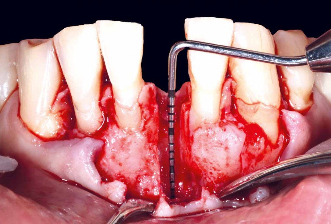 botiss cerabone and mucoderm for bone regeneration and implant supported rehabilitation of a periodontally involved incisor - clinical case