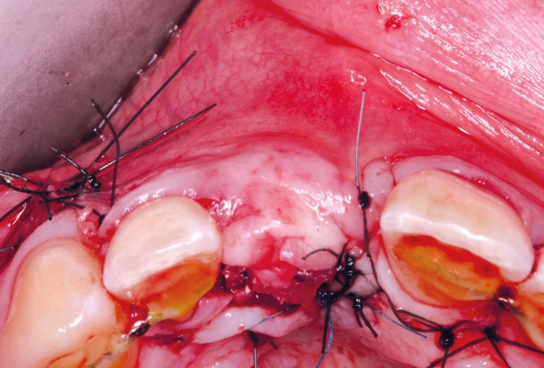 Delayed implant placement with GBR and soft tissue augmentation at the aesthetic area  -  2 years follow up – Dr. H. Maghaireh & Dr. V. Ivancheva
