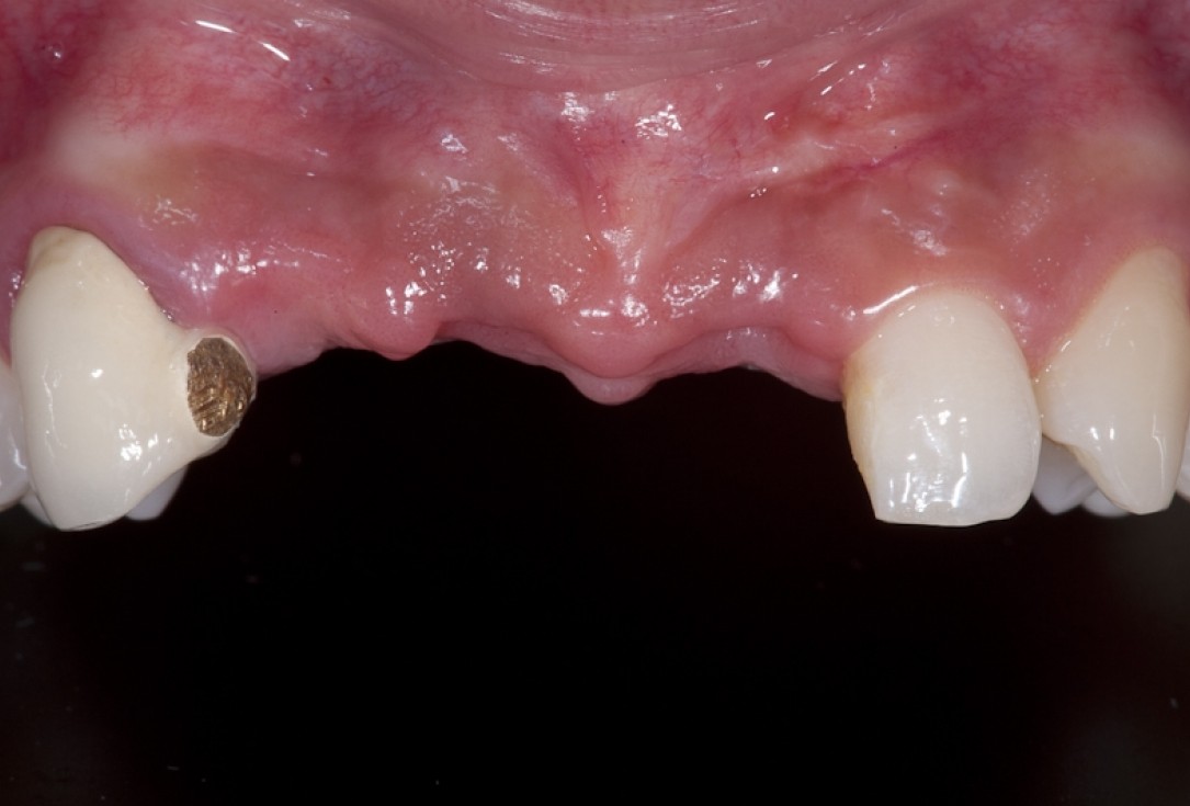 Block augmentation with maxgraft® block and mucoderm® - Dr. K. Chmielewski