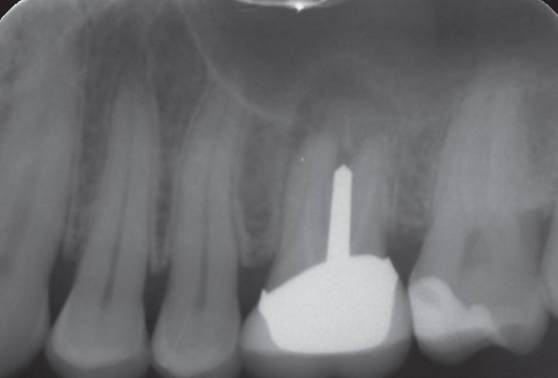 01/10 Internal sinus lift with maxresorb® inject - case Dr. Frank Kistler