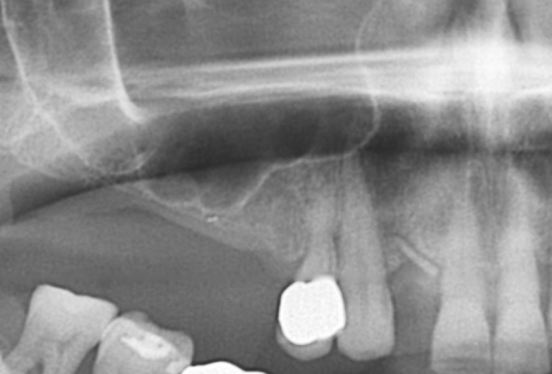 01/20 GBR with maxresorb® and Jason® membrane - Prof. Dr. Dr. D. Rothamel