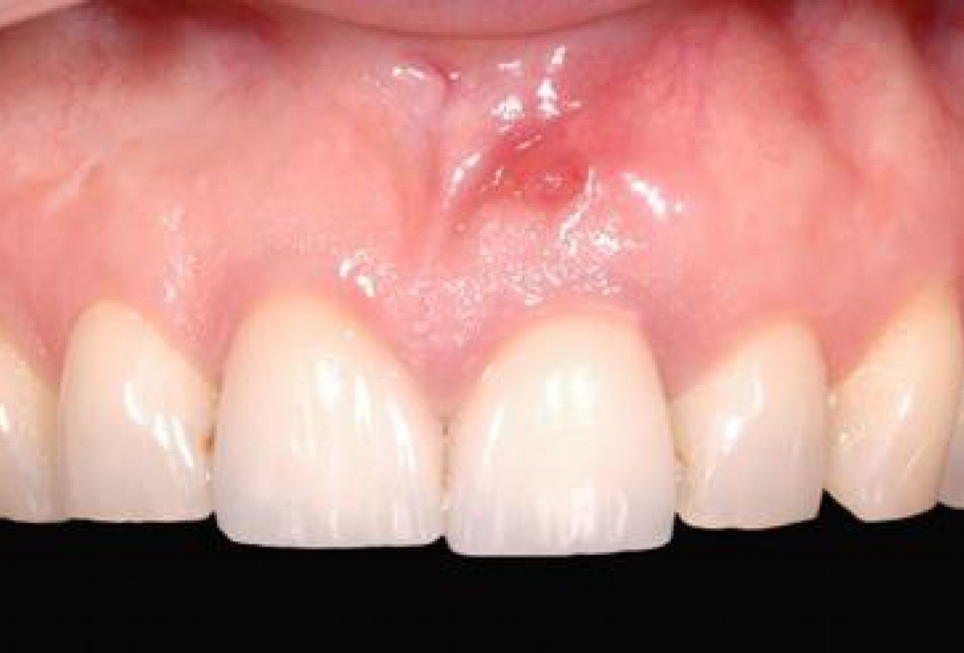 GBR together with soft tissue augmentation with mucoderm® and maxresorb® - Scherg