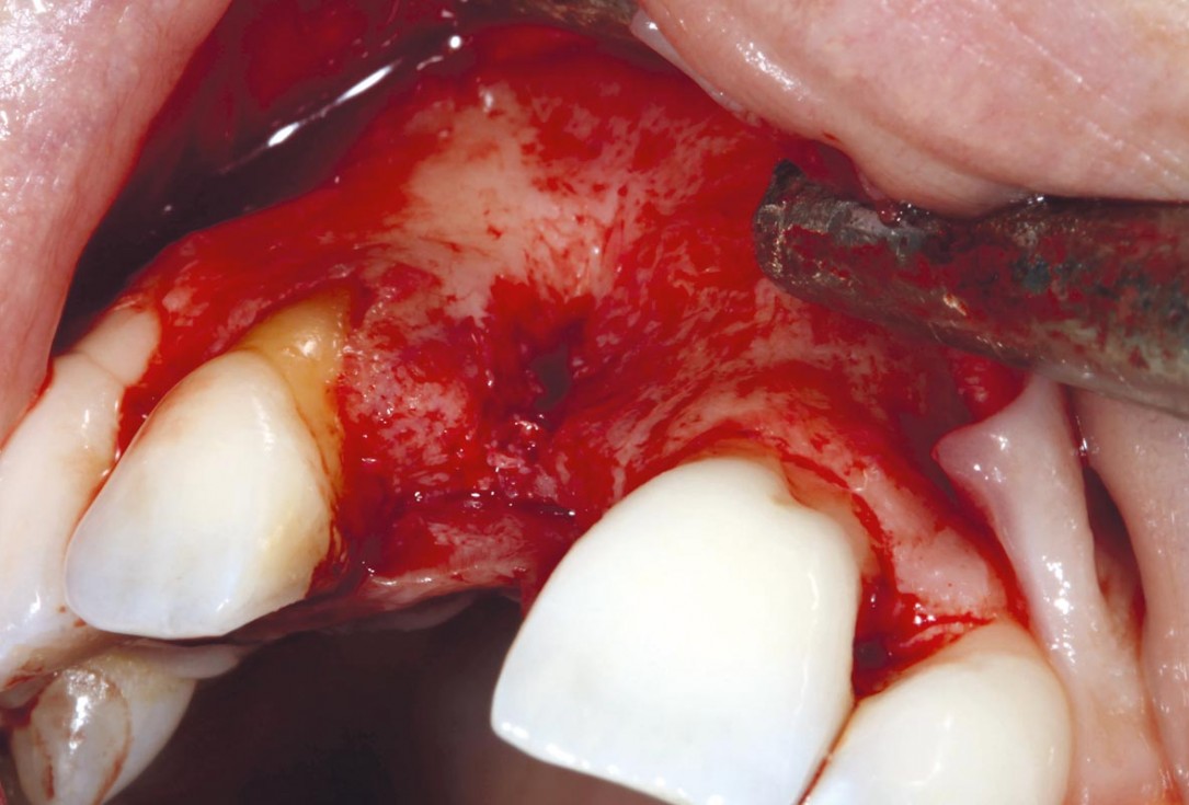 1/11 maxgraft® cortico at combined defect palatally and facially - Dr. K. Höckl