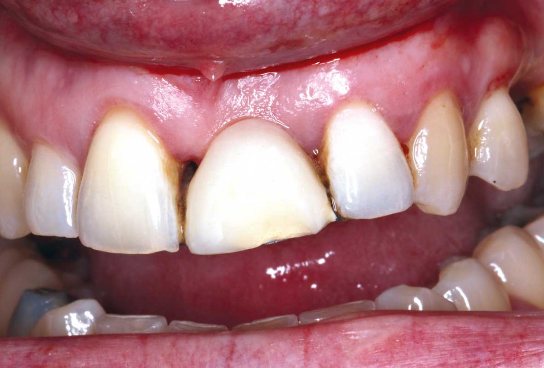 Block grafting in the aesthetic zone with maxgraft®, Jason® membrane and cerabone® - Dres. H. Maghaireh and V. Ivancheva