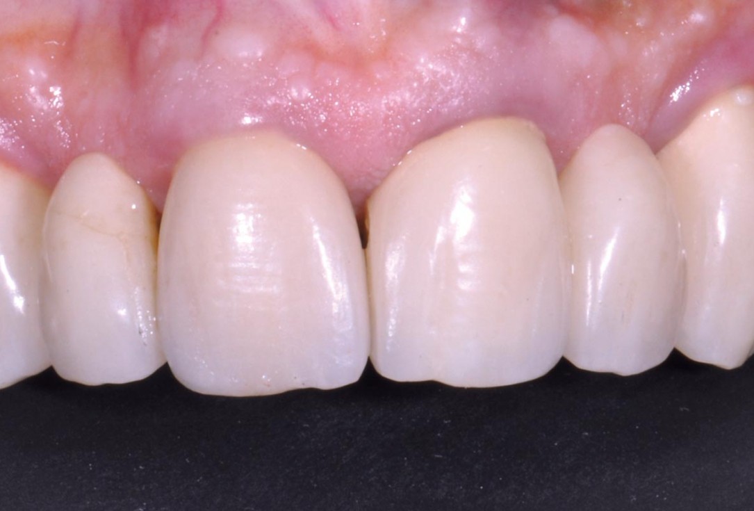 Hard and soft tissue management in immediate restoration