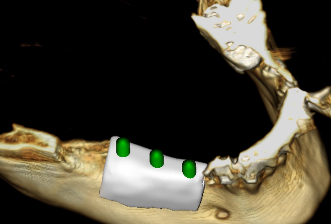 Ridge augmentation with maxgraft® bonebuilder - Dr. M. Jacotti