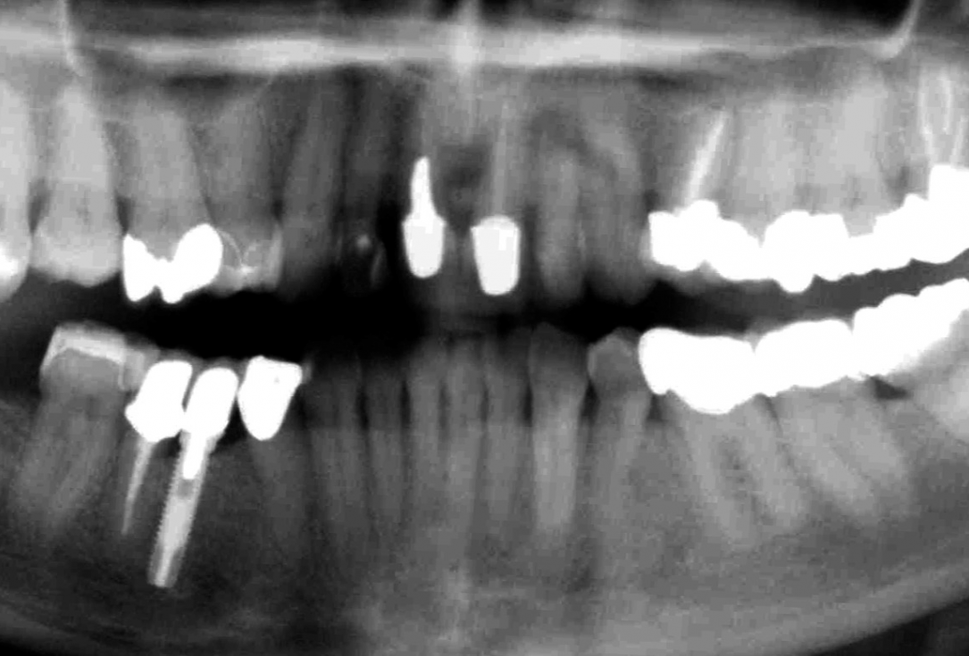 Ridge preservation with cerabone® and Jason® membrane - Dr. Derk Siebers
