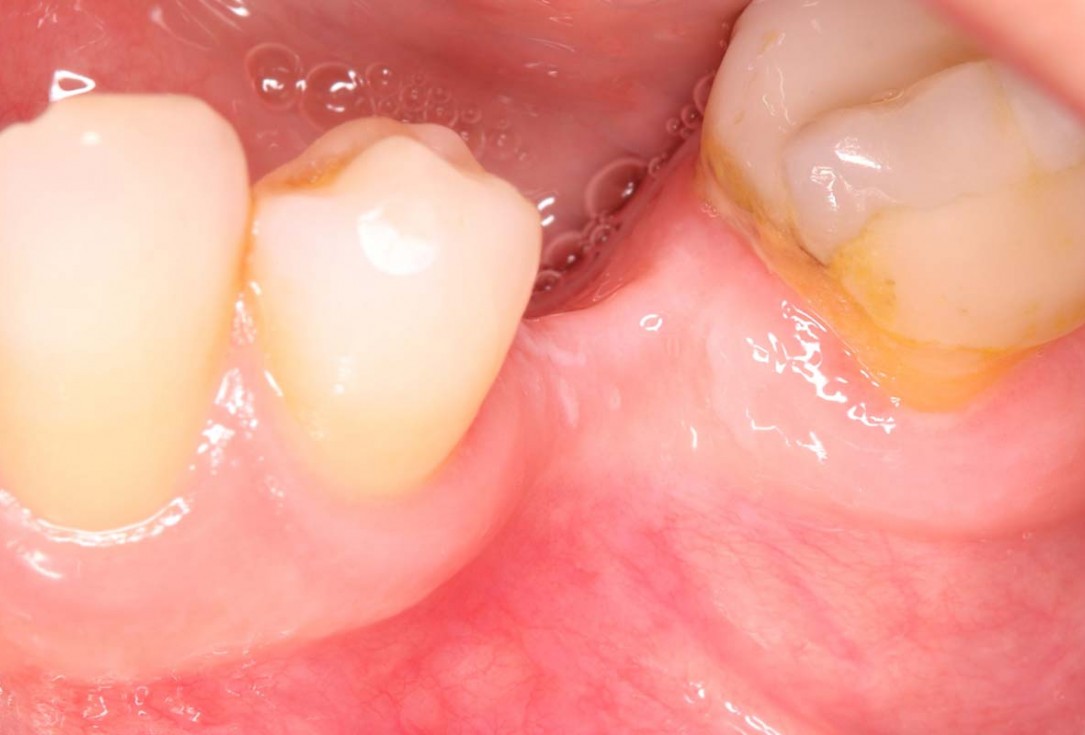 Reconstruction of a single tooth defect with the shell technique - Dr. Andoni Jones