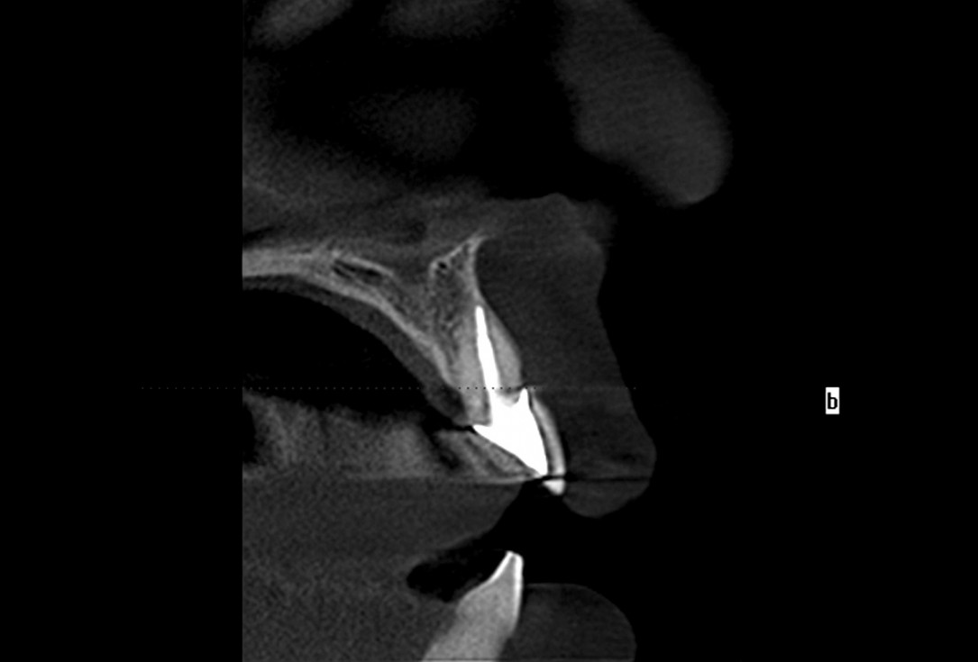 Excellent aesthetic result of buccal augmentation with mucoderm® and maxgraft® after immediate implant placement - 3-years follow-up - Dr. A. Puišys 