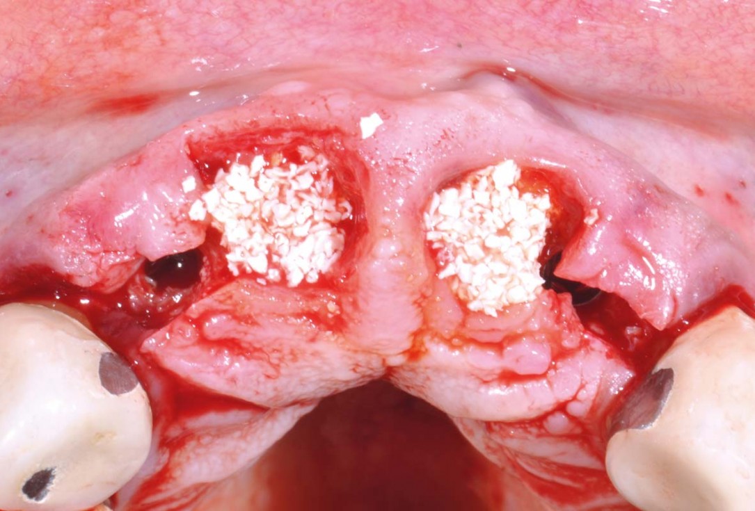 Hard and soft tissue management in immediate restoration