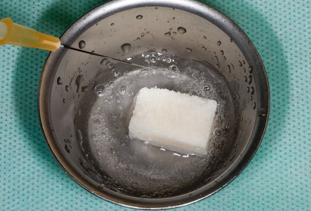 Block augmentation with maxgraft® block and mucoderm® - Dr. K. Chmielewski