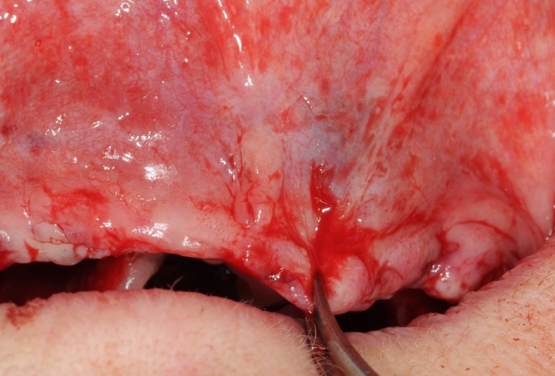 Reconstruction of maxillary ridge with maxgraft® block - Amit Patel