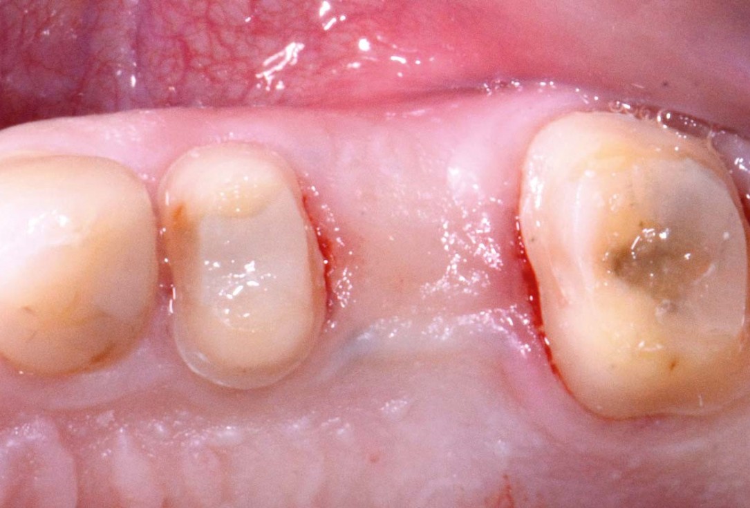 Full bone regeneration in extraction socket augmented with maxgraft® and Jason® membrane – Dr. C. Landsberg