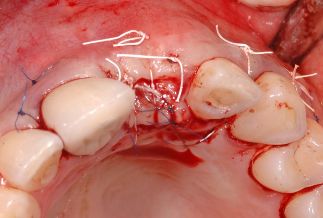 GBR together with soft tissue augmentation with mucoderm® and maxresorb® - Scherg