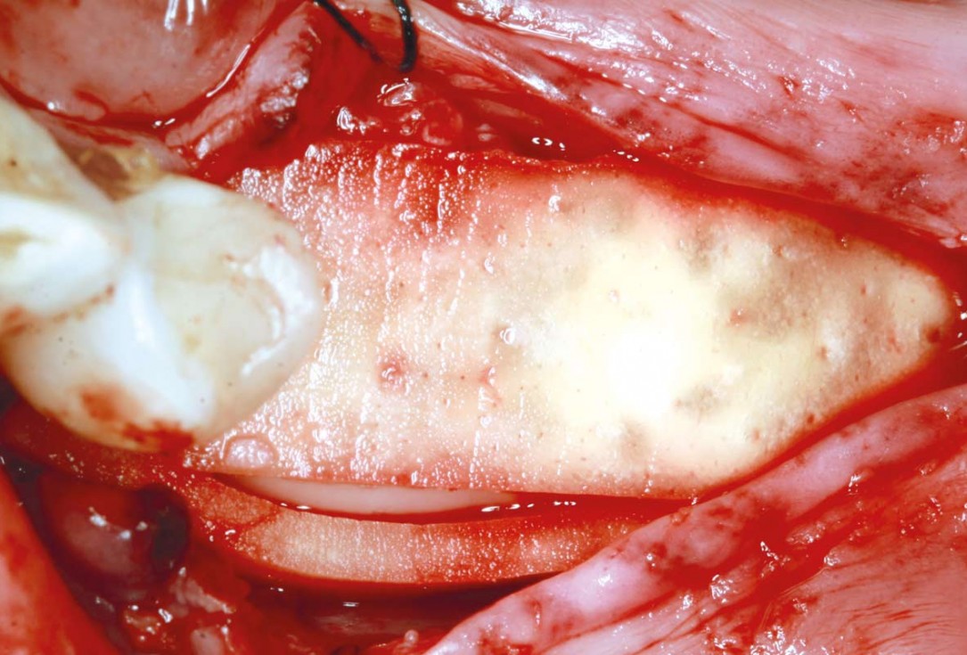 maxgraft® cortico at free-end situation in the mandible - J. Kielhorn