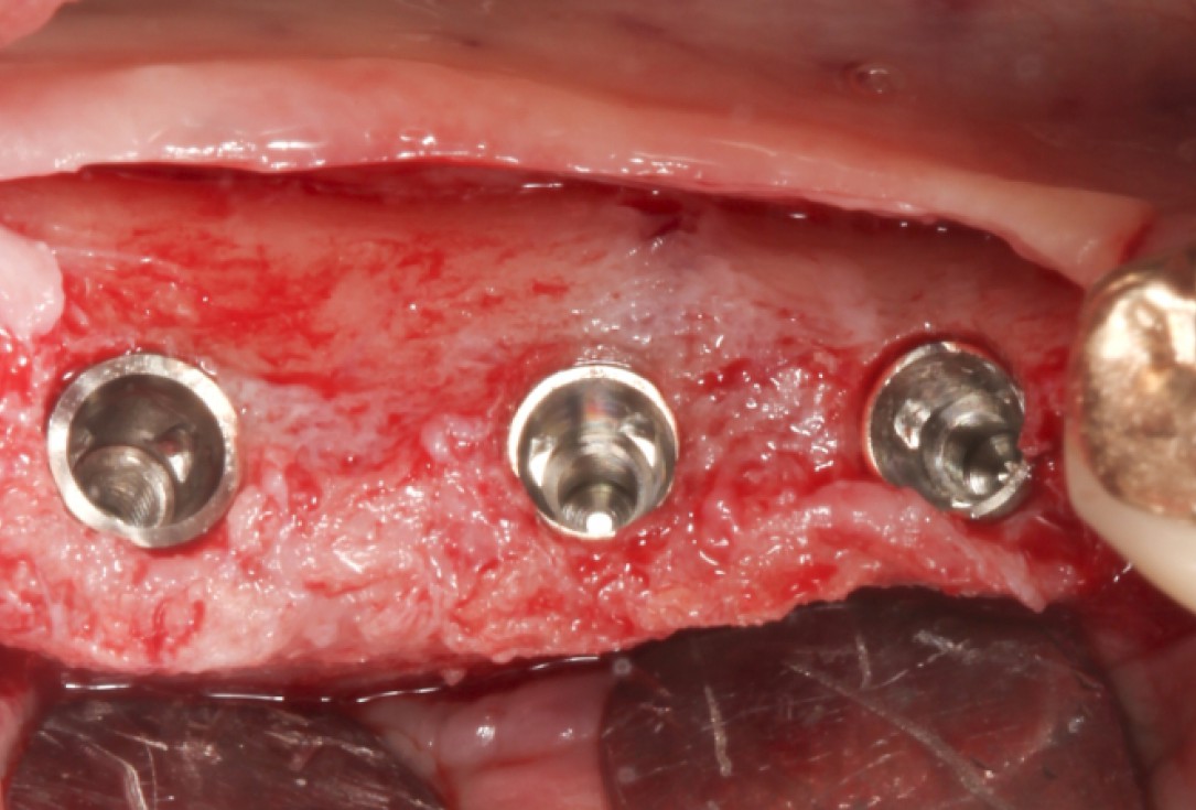 Ridge augmentation with maxgraft® bonebuilder - Dr. M. Jacotti