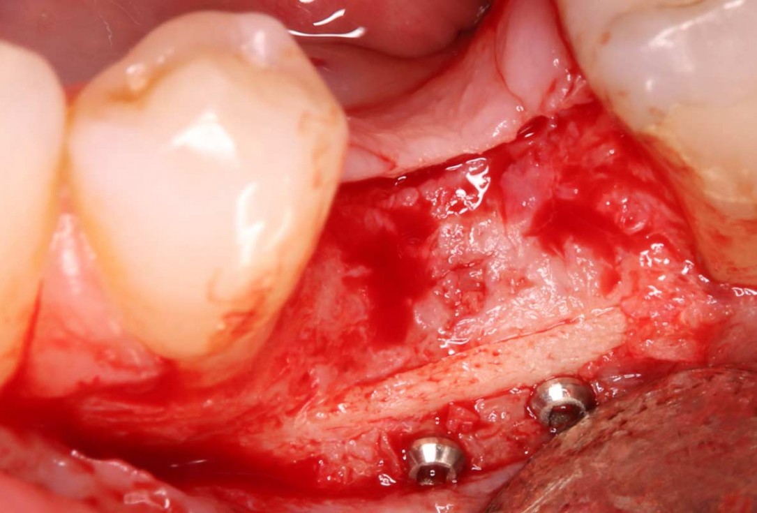 Reconstruction of a single tooth defect with the shell technique - Dr. Andoni Jones
