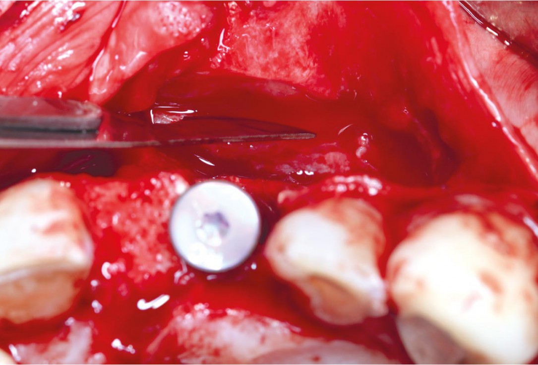 GBR using layering technique in aesthetic zone with maxgraft® and cerabone® -Dr. H. Maghaireh and Dr. V. Ivancheva