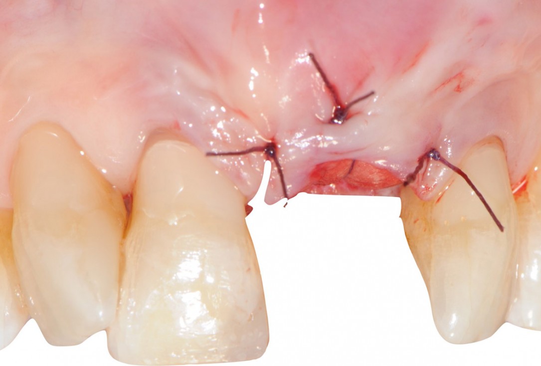 11/18 Tooth extraction and socket sealing with mucoderm® - Dr. A. Rossi