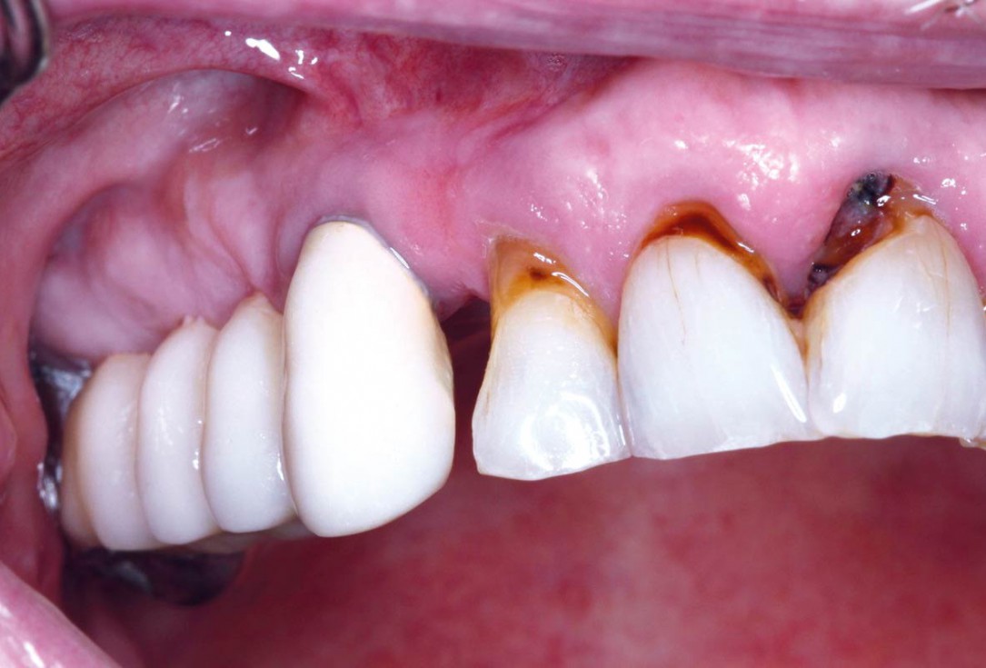 Regeneration with mucoderm® after fibroma resection