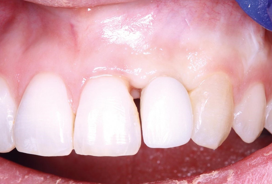 Simultaneous GBR and implantation using maxgraft® granules and autologous bone