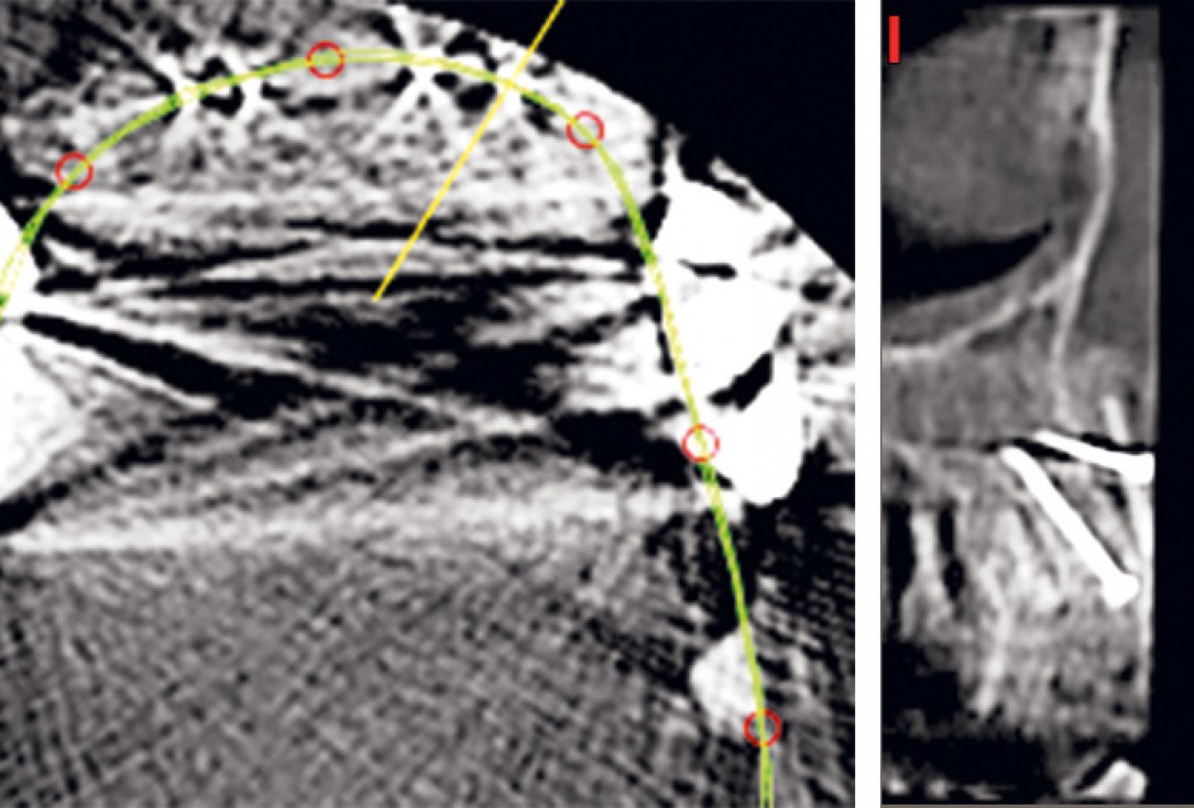 Three-dimensional augmentation with maxgraft® cortico - M.Sc. E. Kapogianni