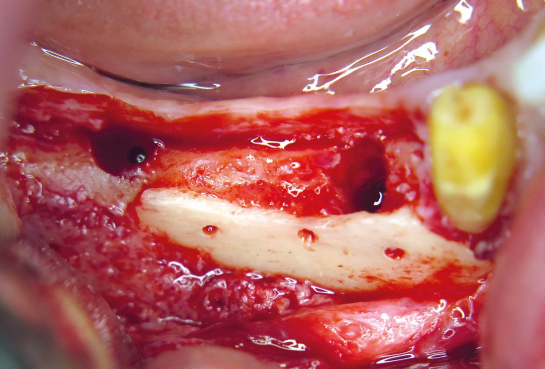 Horizontal ridge augmentation with maxgraft® cortico - M.Sc. E. Kapogianni