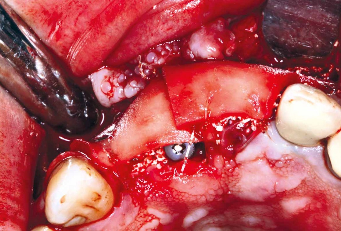 GBR and soft tissue augmentation with cerabone® and mucoderm® - H. Maghaireh & V. Ivancheva