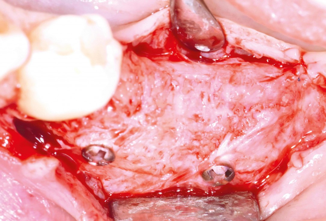 Ridge augmentation in the mandible with maxgraft® bonebuilder– Dr. R. Morger