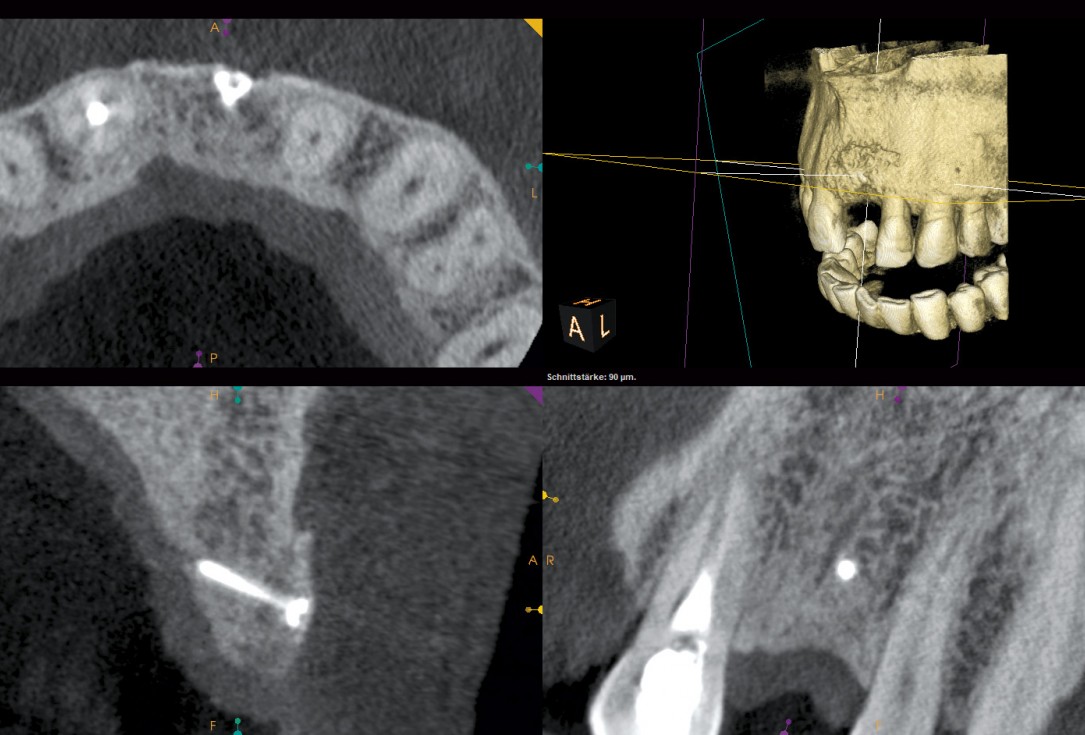 Block augmentation with maxgraft® and cerabone® – Dr. F. Kloss