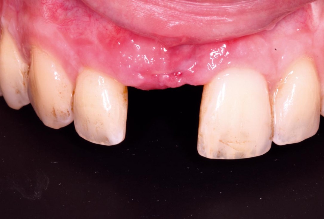 Delayed implant placement with GBR and soft tissue augmentation at the aesthetic area  -  2 years follow up – Dr. H. Maghaireh & Dr. V. Ivancheva